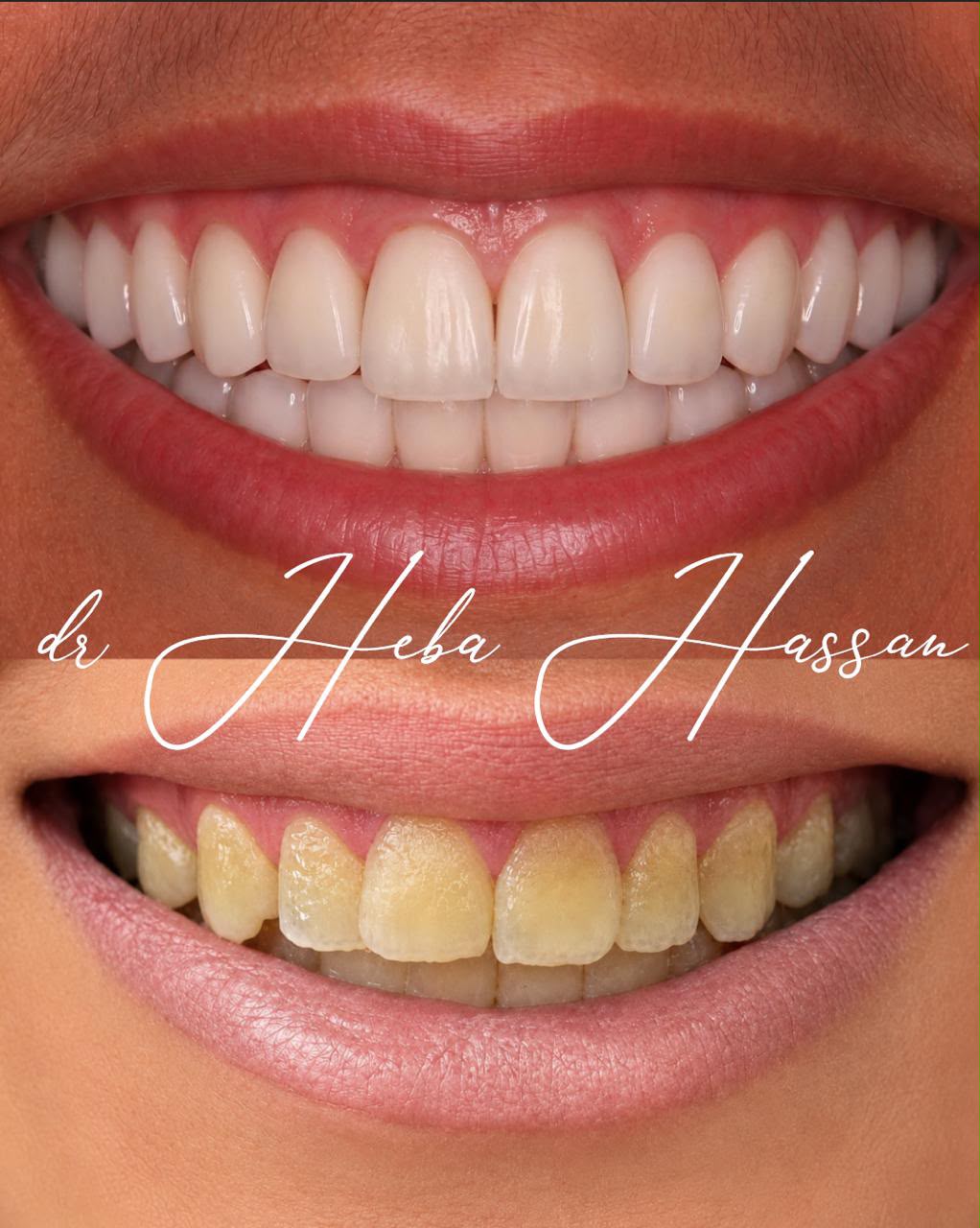 Types of Dental Veneers: Materials and Treatment Options